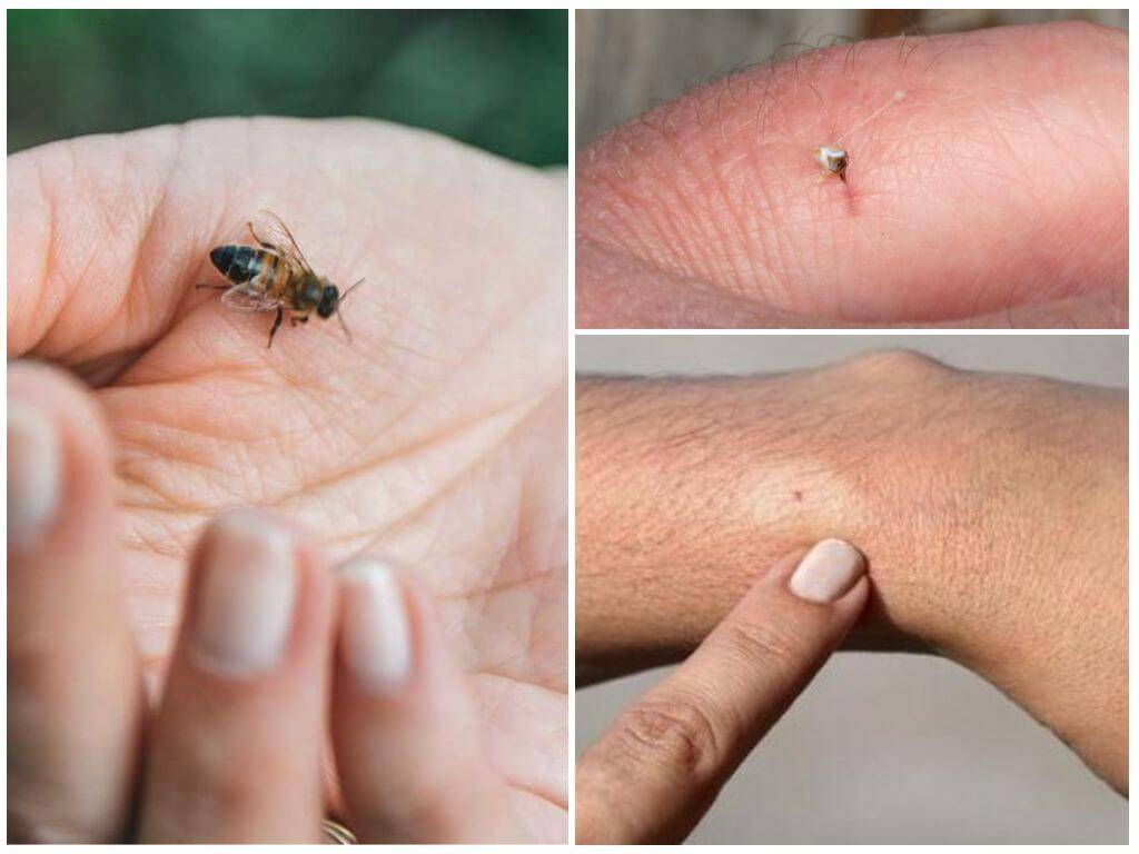 Аллергия на яд насекомых. лечение анафилаксии. что нужно знать врачу и пациенту | университетская клиника