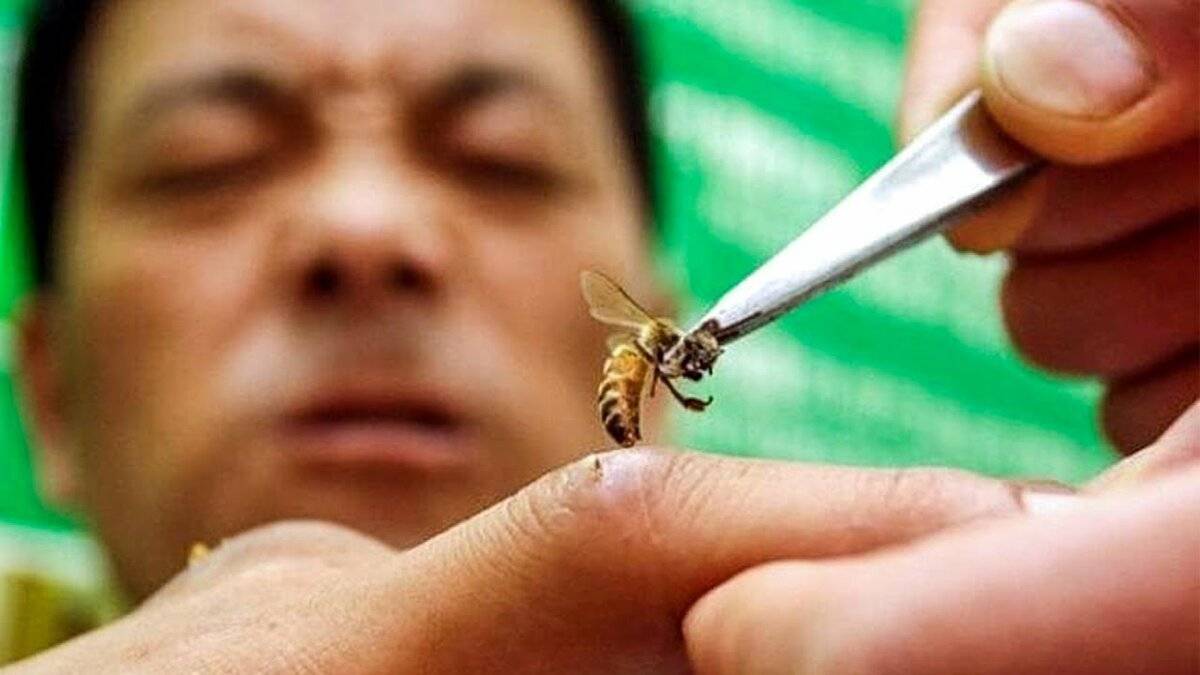 Оказание первой помощи при укусах насекомых: пчелы, осы, шершни, клещи
