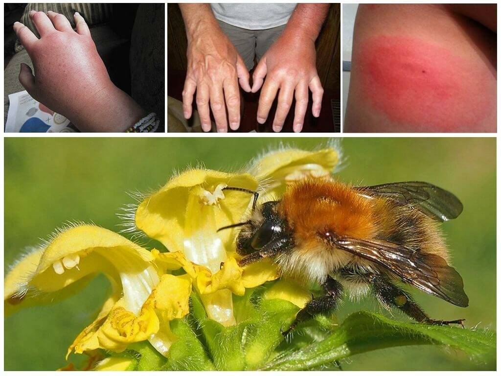 Что делать, если вас укусила оса или пчела, и первая помощь при укусах