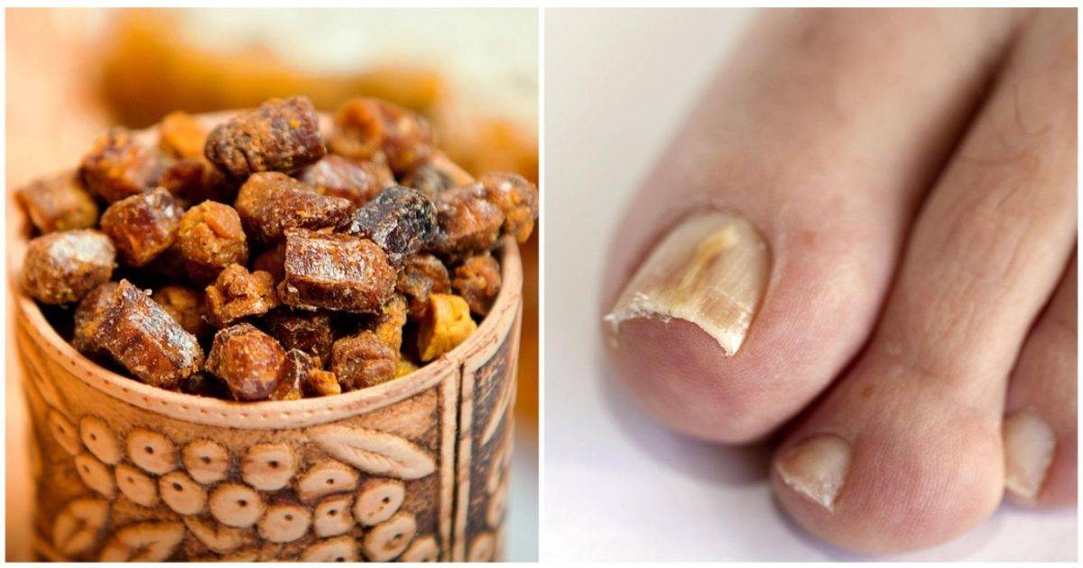 Прополис от грибка ногтей на ногах и руках: рецепт и правила приема