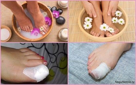 Прополис от грибка ногтей на ногах: 5 рецептов и отзывы о лечение
