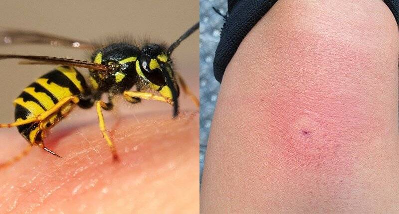 Что делать, если укусили шмель, шершень, оса или пчела?