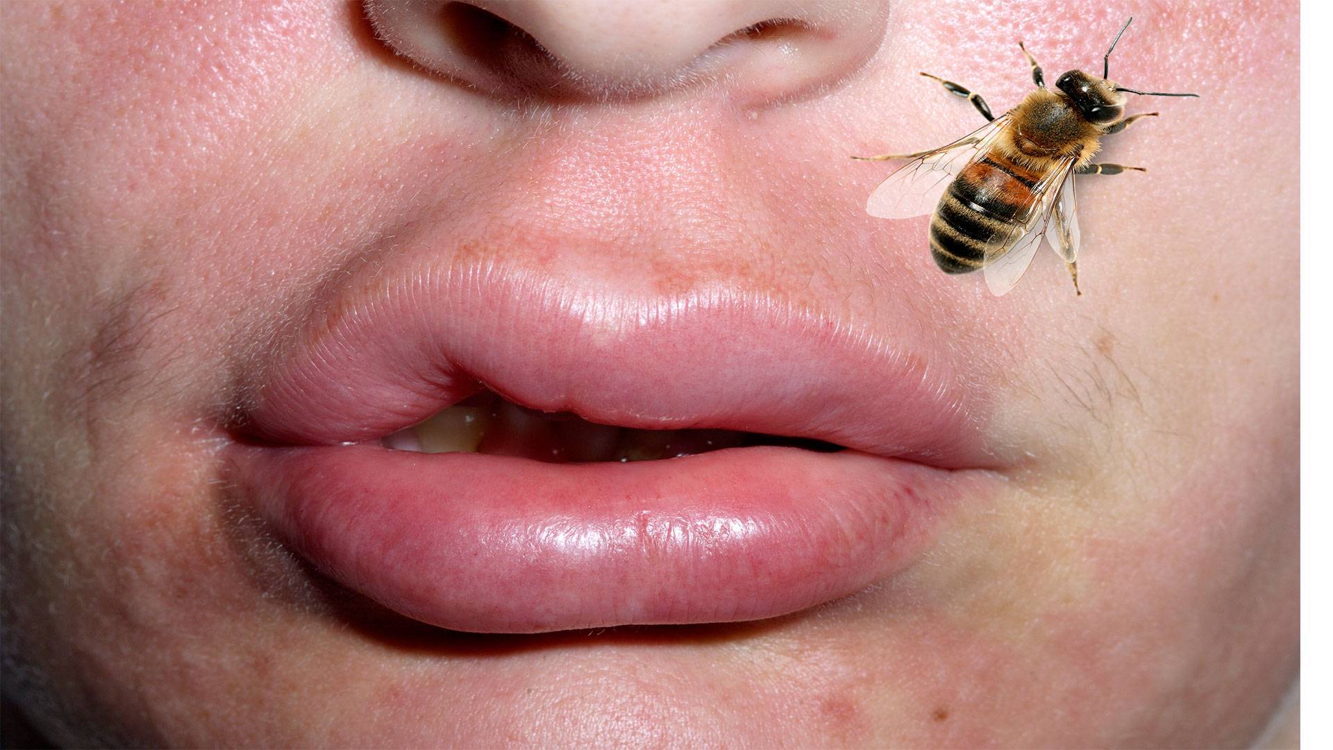 Аллергия на укус осы: что делать. симптомы аллергии на укус осы, а также пчелы