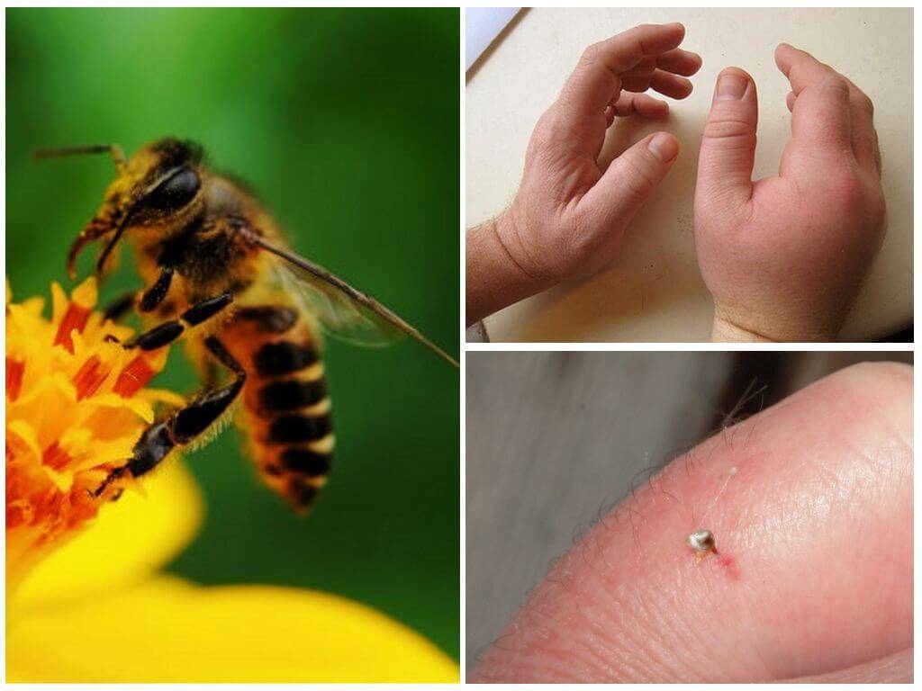 Первая помощь при укусе пчелы: как вытащить жало, что помогает снять отек