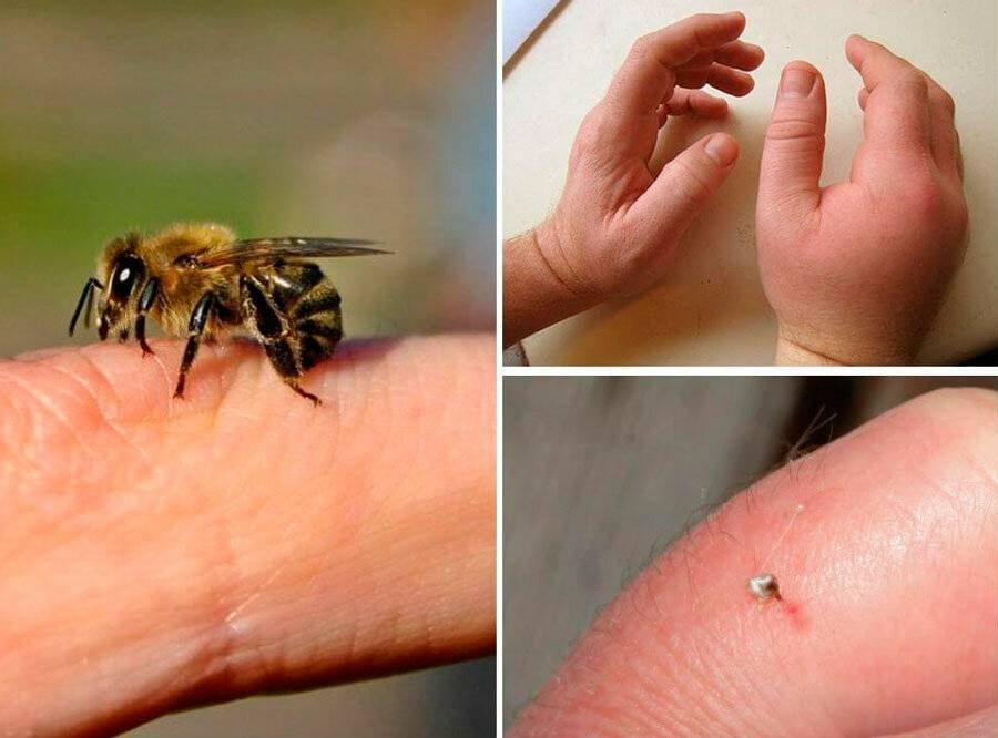 Что делать, если оса или пчела укусила в голову