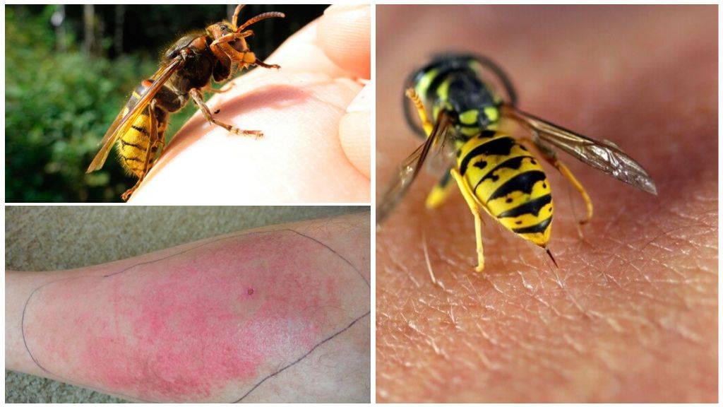 Аллергия на укус пчел и ос