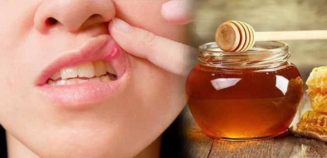 Лечение и профилактика стоматита, используя мед