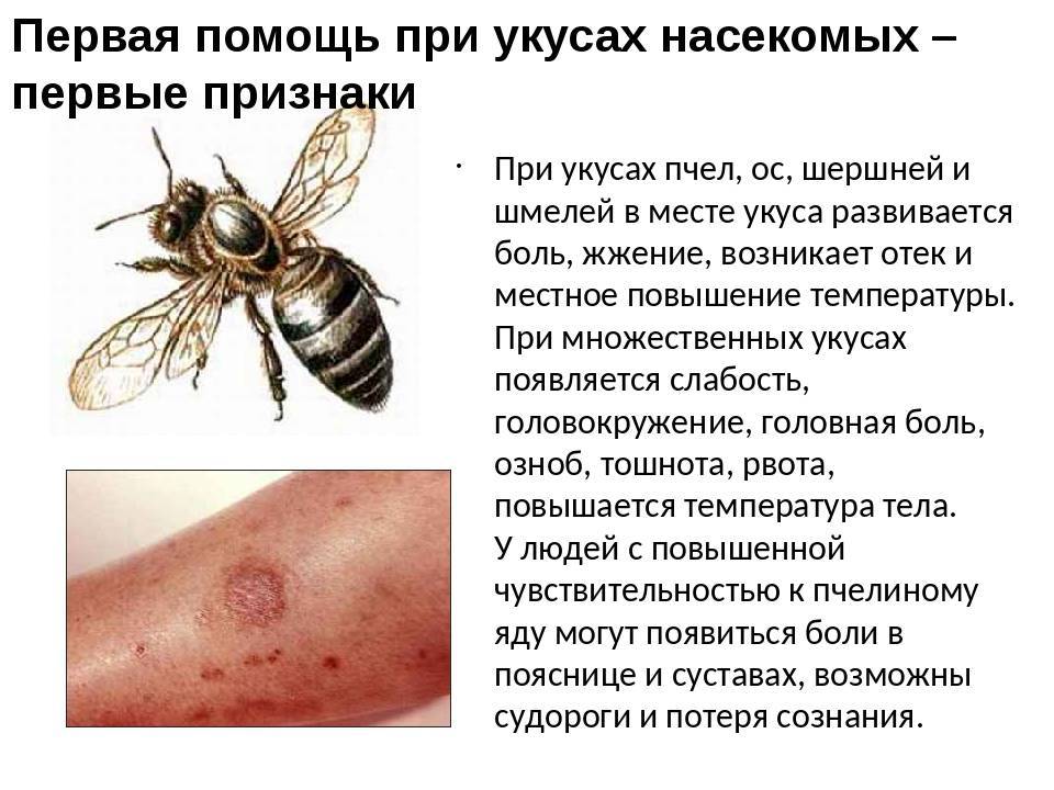 Что делать, если ребенка укусила пчела