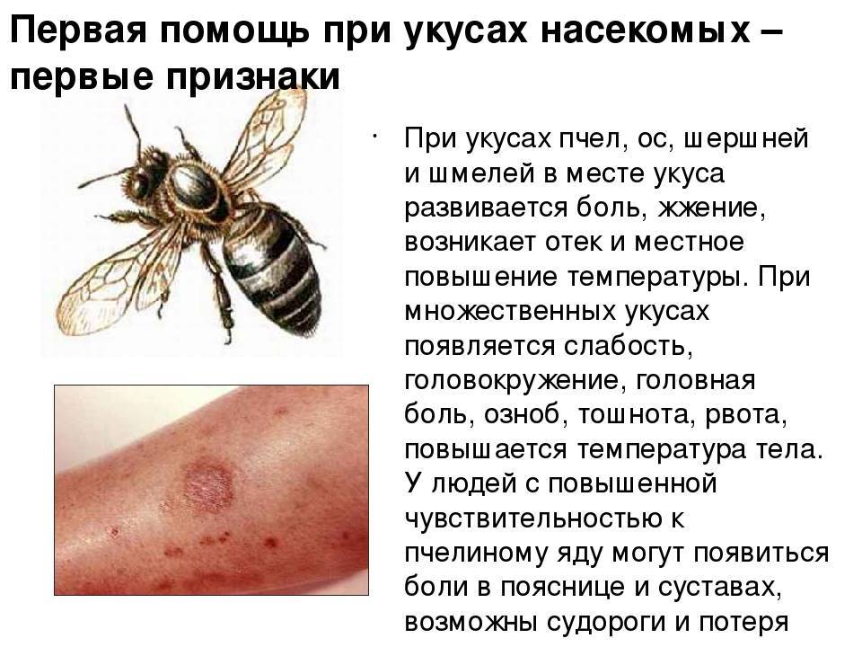Укус пчелы: первая помощь при отёке