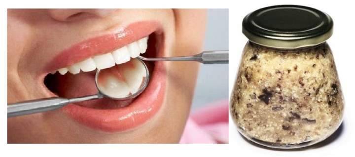 Воспаление зубов (десен) - дента