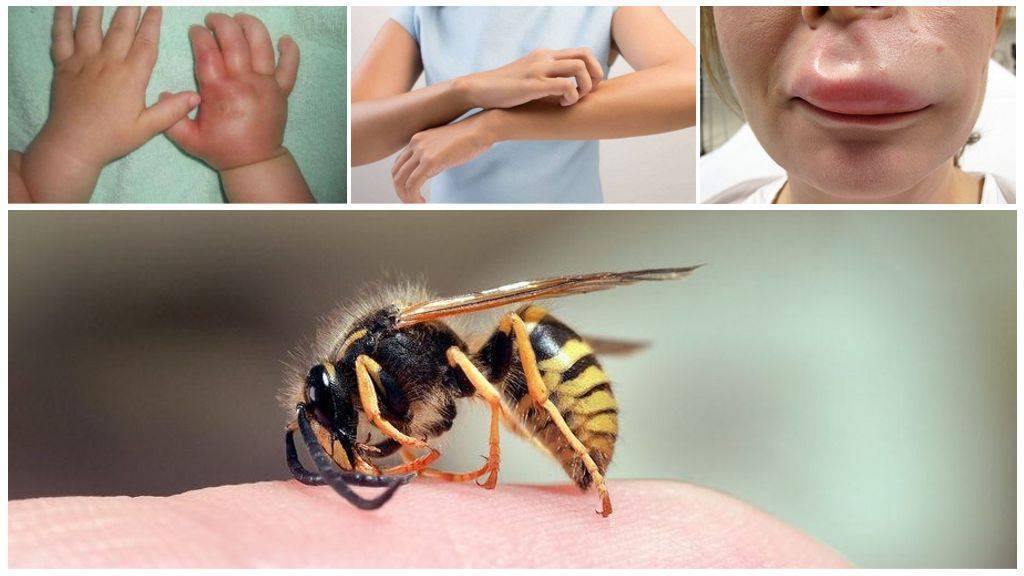 Укус пчелы первая помощь в домашних условиях: признаки, первая помощь, последствия, профилактика