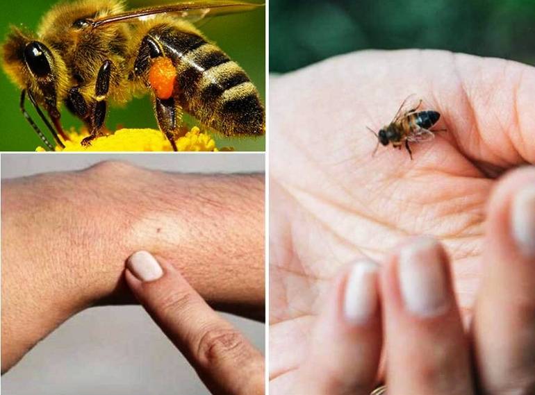Аллергия на яд насекомых. лечение анафилаксии.  что нужно знать врачу и пациенту