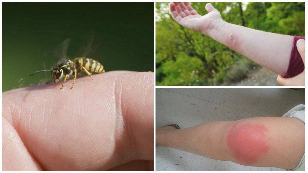 Реакции на ужаления насекомых - как проявляются и что делать?